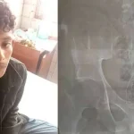 এক্স-রে করে যুবকের পেটে আড়াই হাজার ইয়াবা শনাক্ত