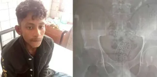 এক্স-রে করে যুবকের পেটে আড়াই হাজার ইয়াবা শনাক্ত