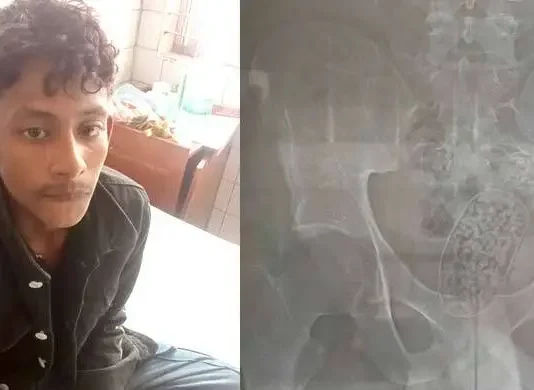 এক্স-রে করে যুবকের পেটে আড়াই হাজার ইয়াবা শনাক্ত